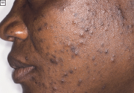 Acne Vulgaris