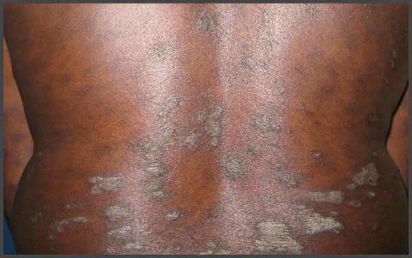 Psoriasis