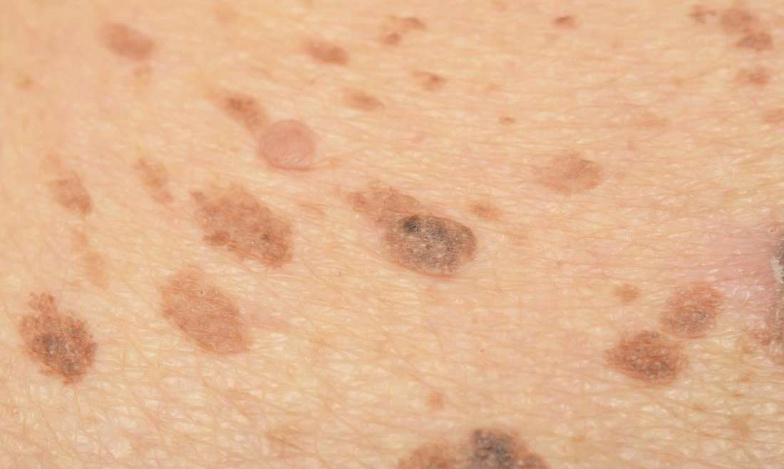 Melasma