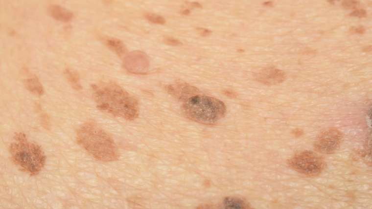 Melasma
