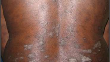 Psoriasis