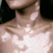 vitiligo vitiligo