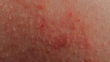 ECZEMA
